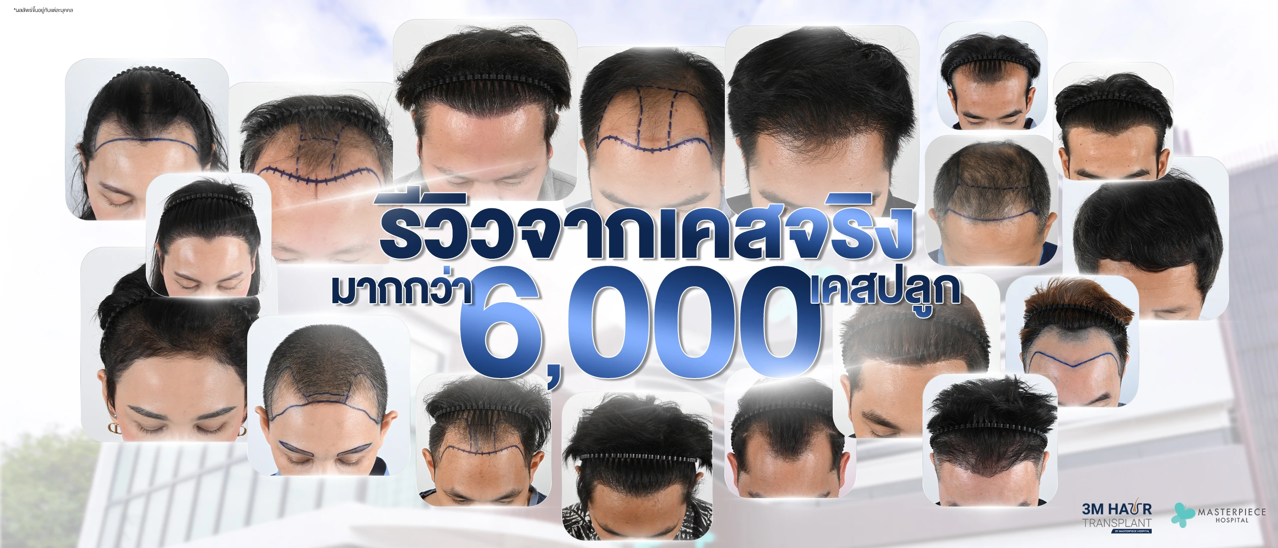 3M HairTransplant
